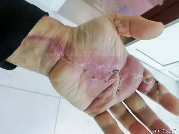 Nizhny Novgorod doctors reattached a man's hand that had been severed by a saw.