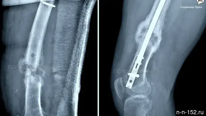 Nizhny Novgorod doctors helped a 43-year-old man recover after a severe injury.
