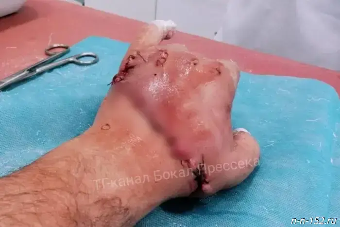 Nizhny Novgorod doctors reattached a man's hand that had been severed by a saw.