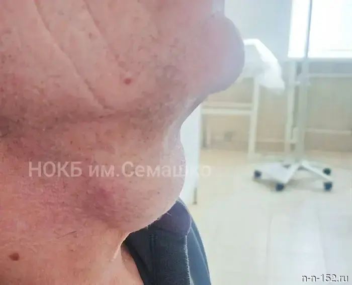 Nizhny Novgorod surgeons removed a cyst the size of an egg from a patient.