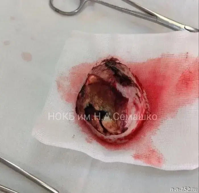 Rare head tumor removed from 87-year-old Nizhny Novgorod woman — photo