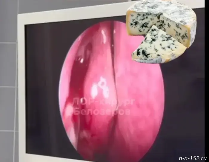 In Nizhny Novgorod, a cheesemaker with a fungal infection in his nose underwent surgery.