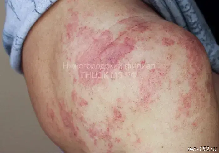 Doctors saved a Nizhny Novgorod woman bitten by a viper.