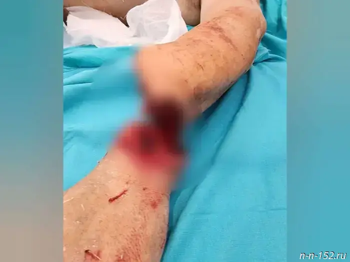 Doctors at PIMU reattached a hand cut off with a saw to a resident of Nizhny Novgorod.